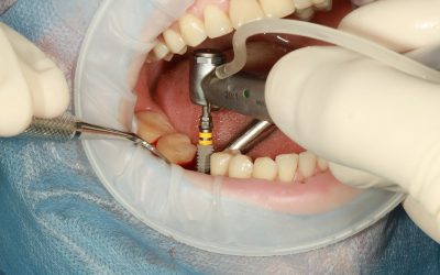 Procedure en herstel bij implantaten