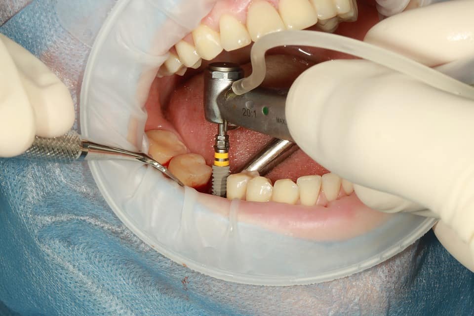 Procedure en herstel bij implantaten